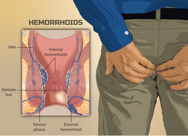 Image showing location of internal and external haemorrhoids and back view of man clutching his bottom