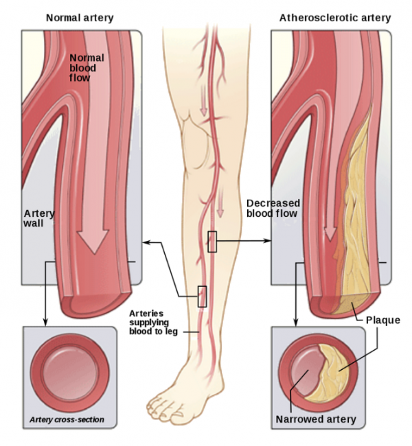 Image showing normal and blocked artery, atherosclerosis