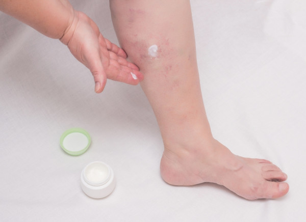 Woman putting ointment on leg with visible reddened veins