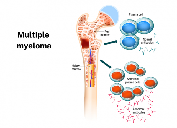 Vector showing yellow and red bone marrow and normal and abnormal plasma cells and antibodies in myeloma