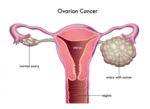 Uterus and ovaries showing one healthy ovary and one with cancer