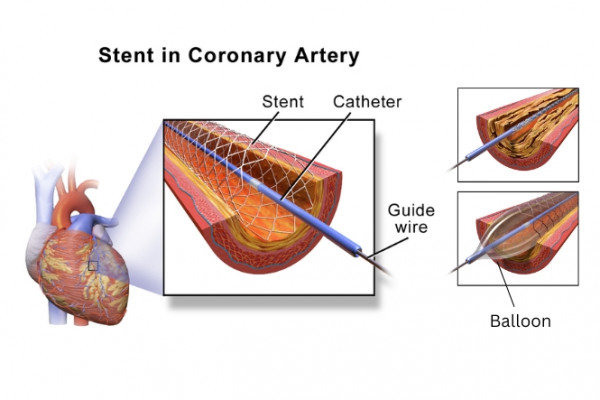Angioplasty image showing artery stent, catheter and balloon