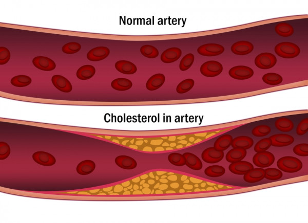 Normal artery and artery with cholesterol build up