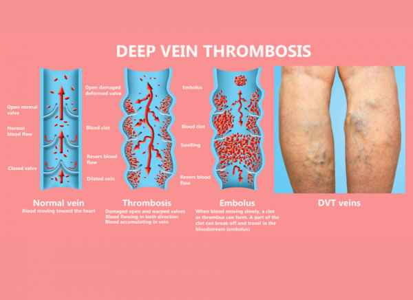 Image showing normal vein thrombosis and embolus