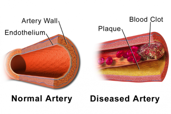 Image of a normal and a diseased artery with plaque and a blood clot