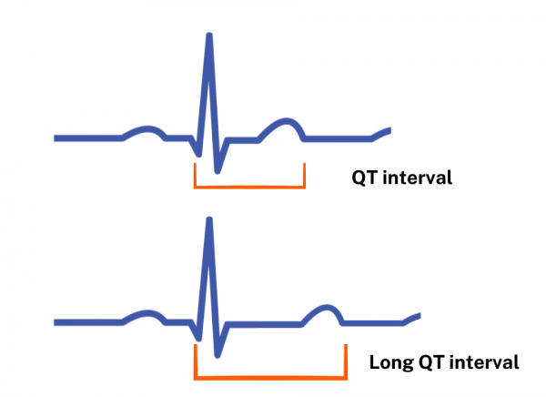 Representation of normal and long QT interval on ECG