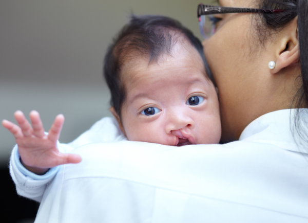Young baby with cleft palate looking over mother's shoulder