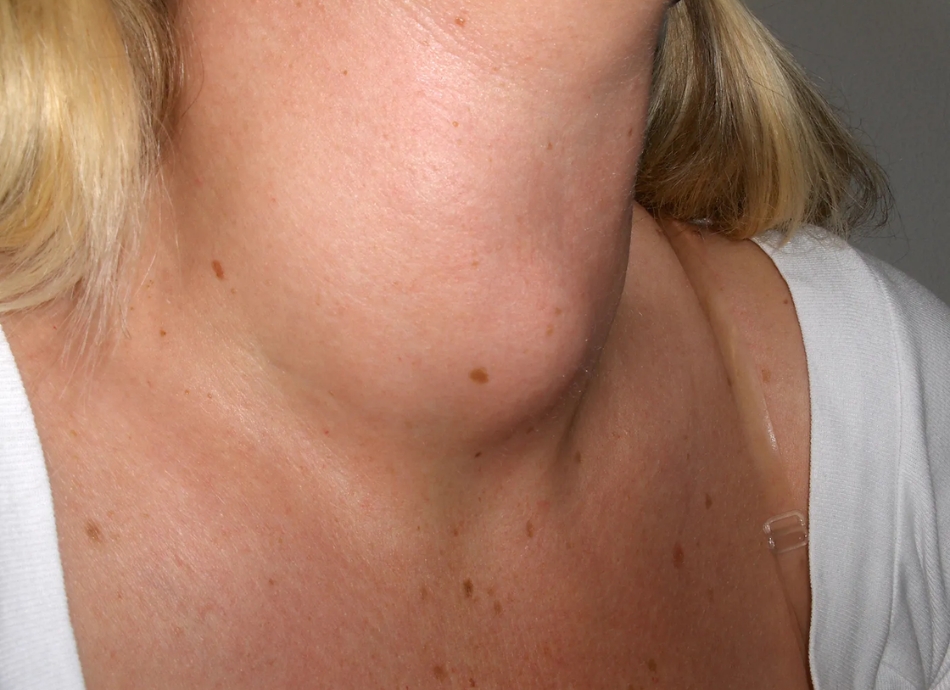 Goitre on woman's neck