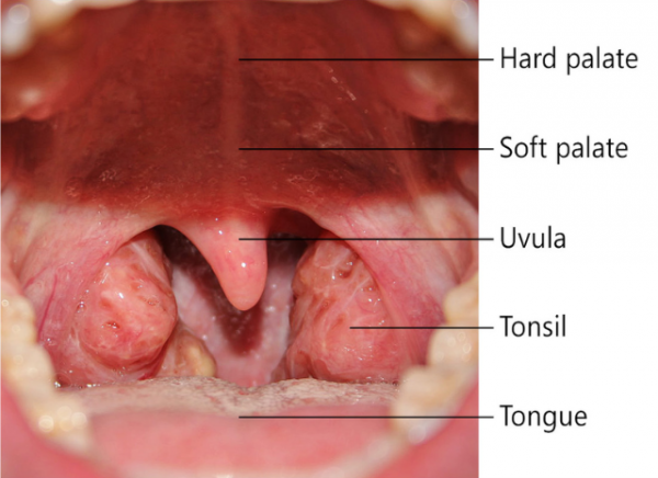 Labelled mouth with swollen tonsils 