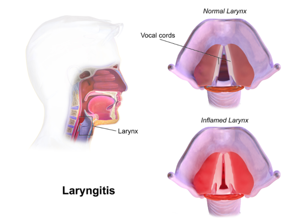 Image of healthy and inflamed vocal cords