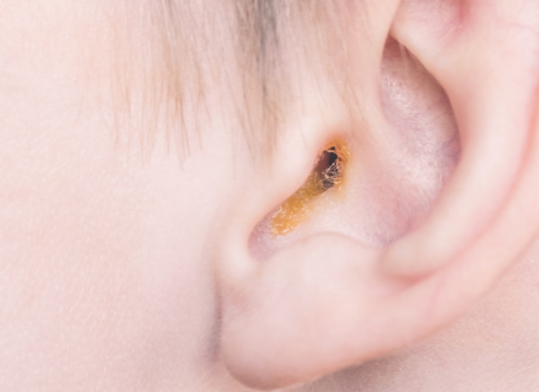 Earwax naturally coming out a child's ear