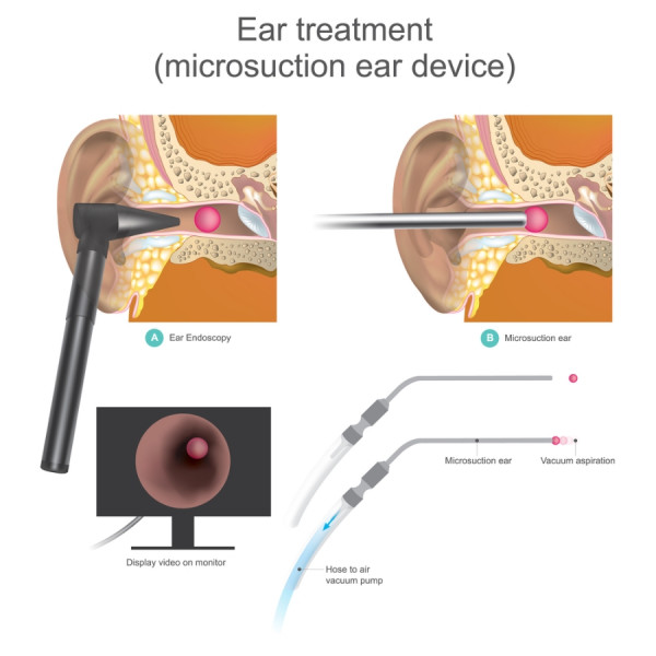 Microsuction device to remove wax from ears