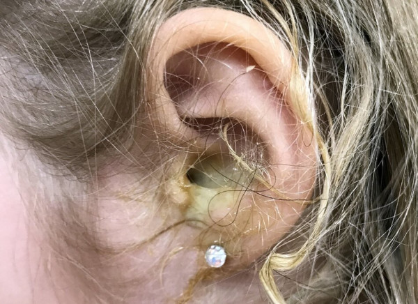 Close-up of girl's ear with pus draining from it