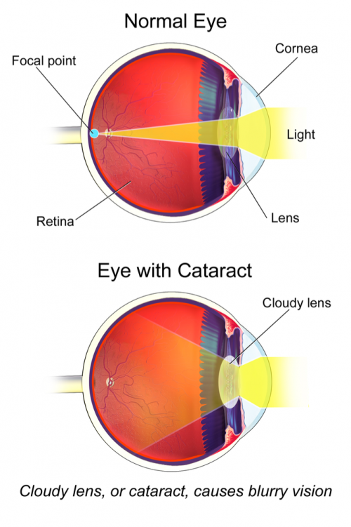 Image showing how a cataract changes the way light focuses on the retina