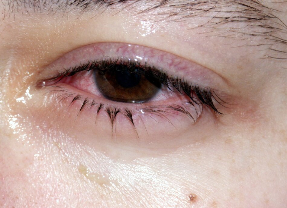 Conjunctivitis in left eye