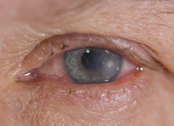 Corneal ulcer in front of iris