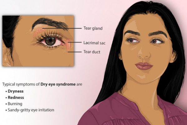 Dry eye image and symptoms