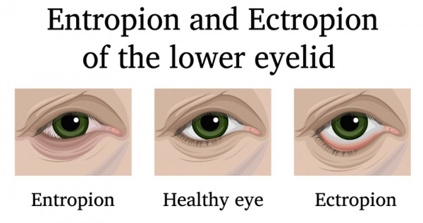 Illustration of healthy eye and eye with entropion and eye with ectropion