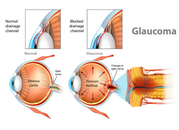 Illustration of how pressure of vitreous fluid in the eye causes glaucoma