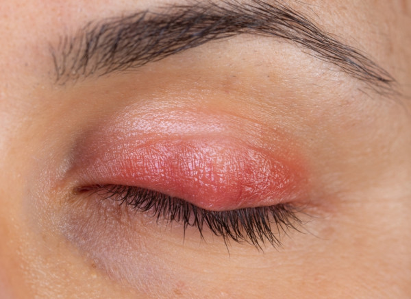 Meibomian cyst or chalazion on an upper eyelid