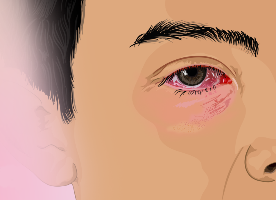 Graphic illustration of red right eye 