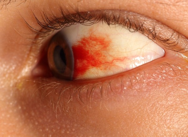 Bleeding in the white of the eye