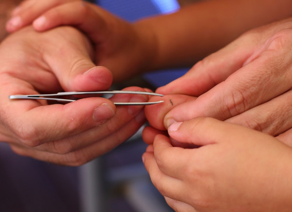 Adult using tweezers to remove splinter from child's toe