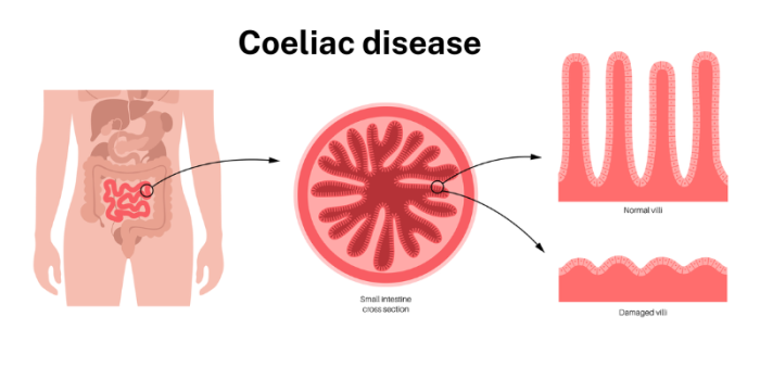 Effects of coeliac disease on villi in gut