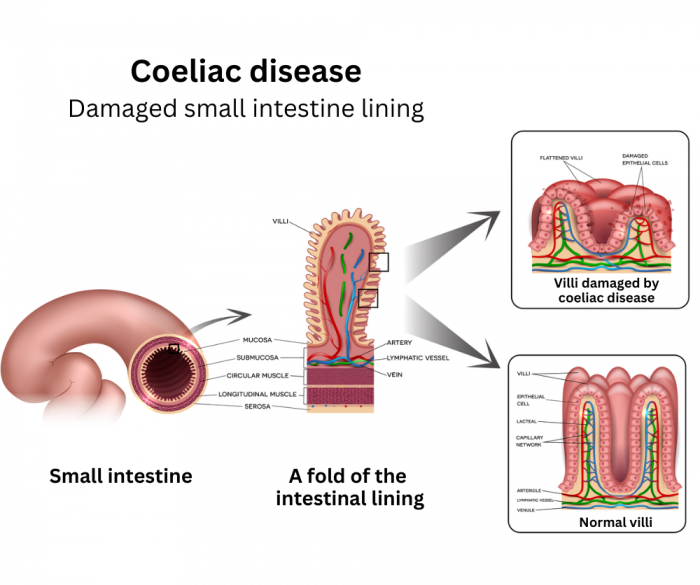 Normal intestine and intestine damaged by coeliac's disease