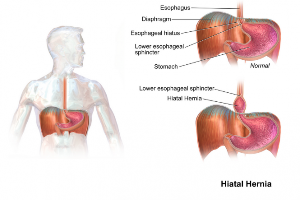 Image showing hernia pushing up through diaphragm