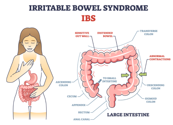 Image of large intestine and different causes of IBS related pain