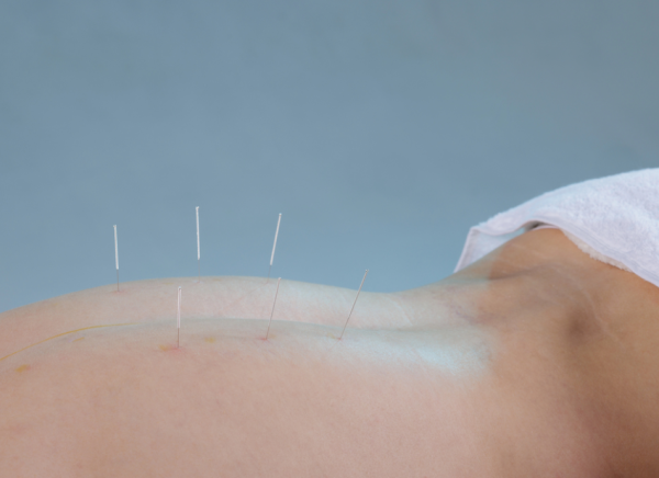 Acupuncture needles in woman's back