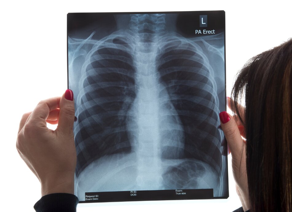 Woman holds up chest x-ray