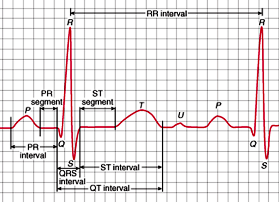 Graphic illustration of ECG printout