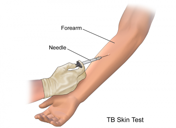 Graphic of TB skin test showing arm, needle and blister on skin