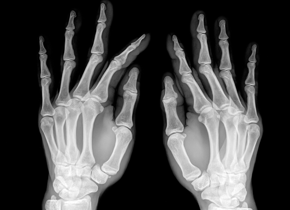 X-ray of both hands