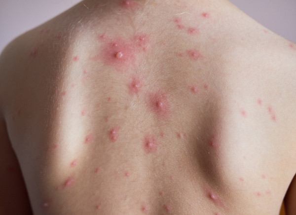 Chickenpox rash with blister on child's back