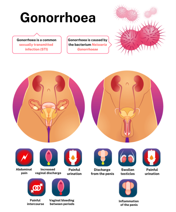 Symptoms of gonorrhoea