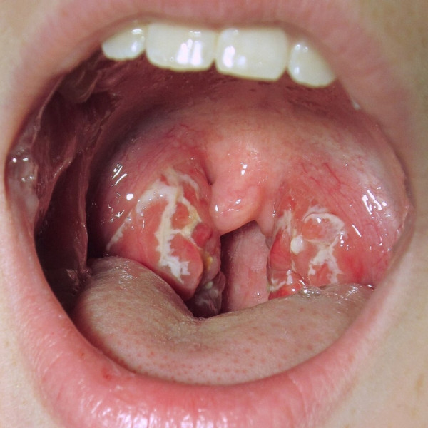 Strep throat showing redness, white spots on tonsils and swollen uvula