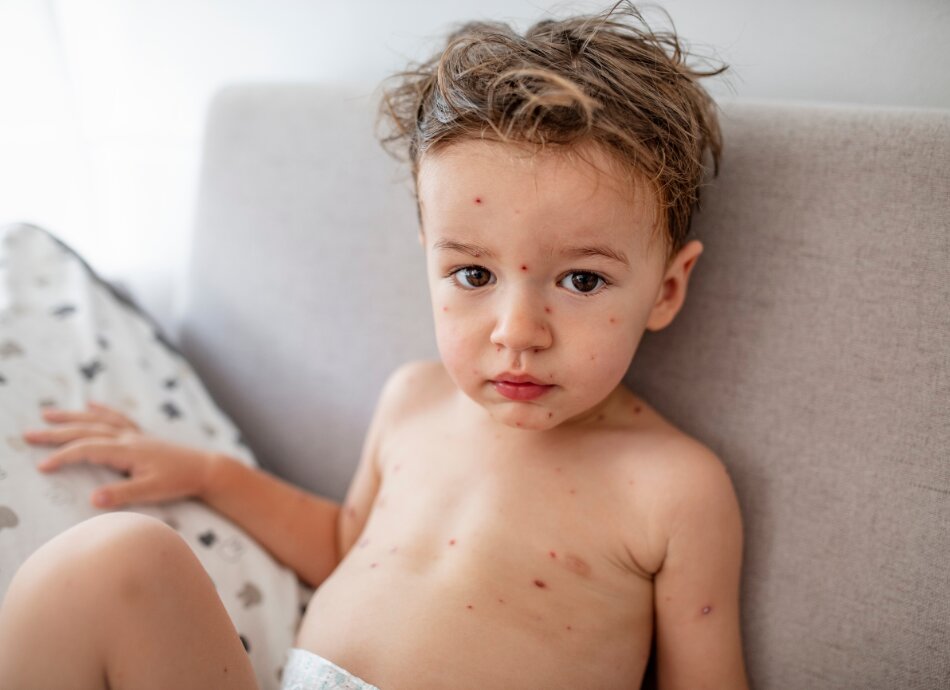 Boy toddler with chickenpox rash on face and torso