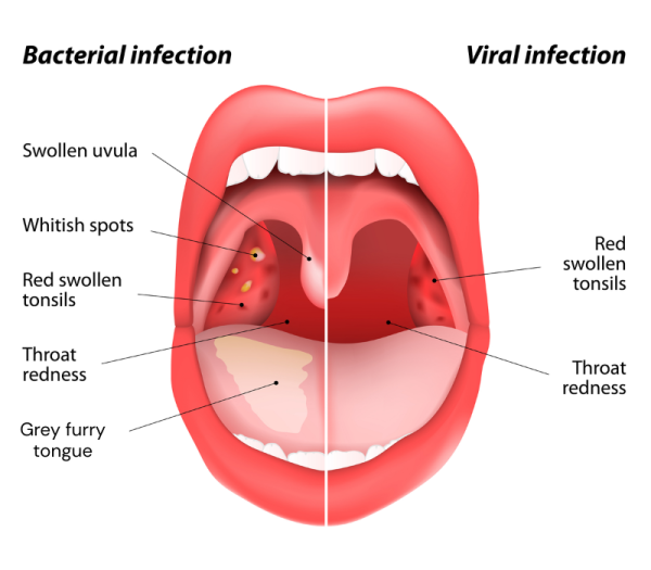 Throat with bacterial infection on one side and viral infection on the other