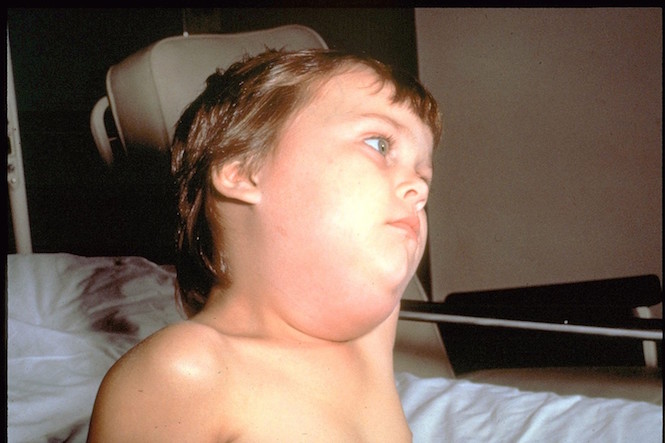 Child with mumps: Sourced from CDC/NIP/Barbara Rice, Public Domain, Wikimedia Commons