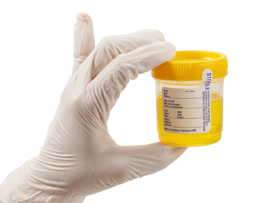 Gloved handing holding urine sample container 