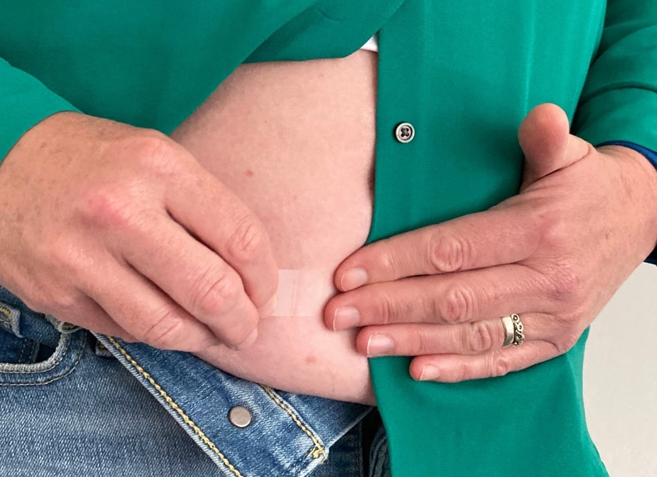 Applying oestrogen patch to stomach