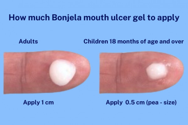 Diagram showing how much Bonjela mouth ulcer gel to use in adults and children 18 months of age and over