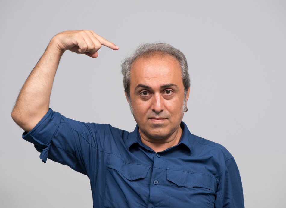 Balding middle-aged man pointing to his hair loss