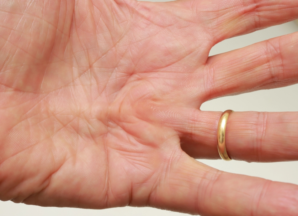 Beginning of Dupuytren's contracture 