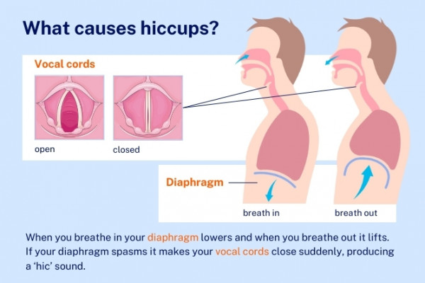Infographic showing diaphragm, vocal cords and cause of hiccups