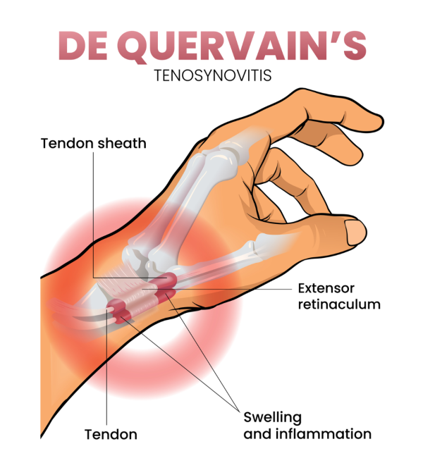 De Quervain's tenosynovitis with an inflamed tendon sheath