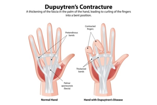Image showing thickened fascia and contraction of fingers with Duputren's